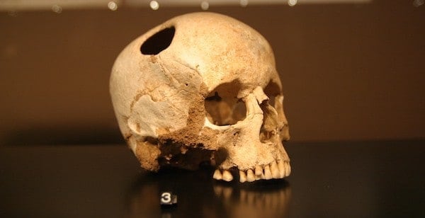Why What You Know About Trepanning Is Probably Wrong