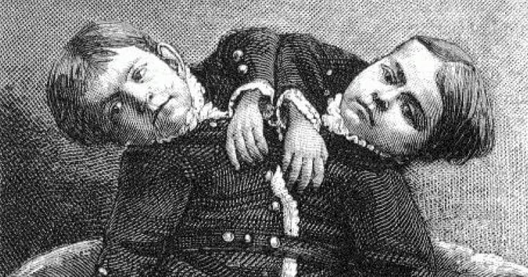 16 Odd Facts About the Tocci Brothers, Famous Conjoined Twins Who Retired at 20